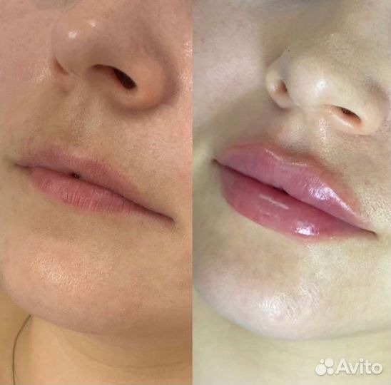 Увеличение губ