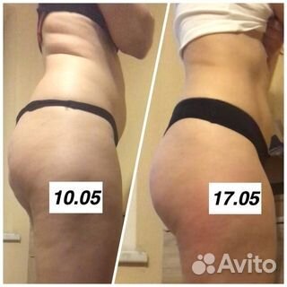 LPG Массаж коррекция фигуры, похудение