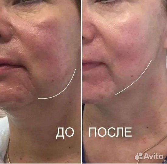 Смас-лифтинг