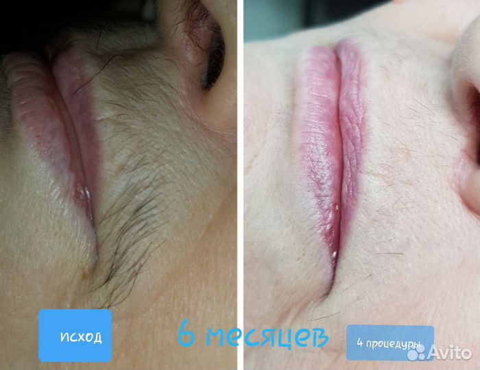 Электроэпиляция