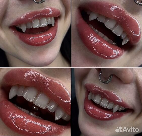 Наращивание клыков