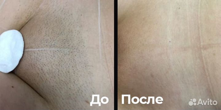 Лазерная эпиляция Диодный лазер