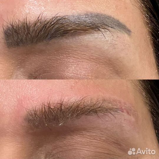 Лазерное удаления перманентного макияжа