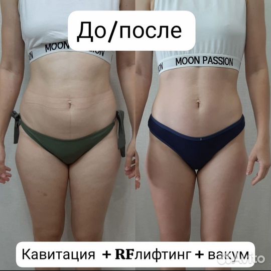 Кавитация, вакум, лазерный липолиз, рф-лифтинг