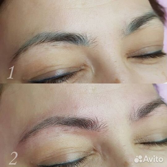 Лазерное удаления перманентного макияжа