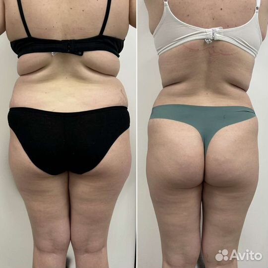 Вакуумный аппаратный массаж, обертывание