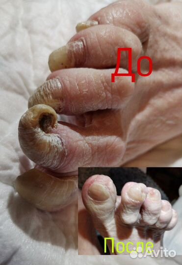 Медицинский педикюр.Выезд на дом.Любой р-он