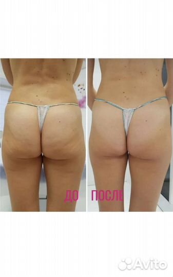 Массаж спины, антицеллюлитный, лимфодренажный