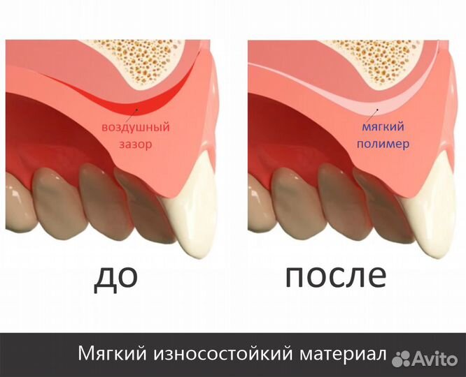 Съемные зубные протезы Состав для перебазировки