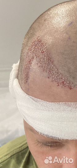 Пересадка волос методом FUE