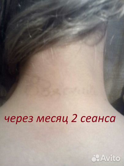 Удаление тату