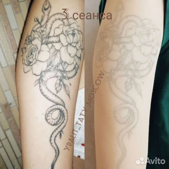 Удаление тату,Татуаж,пилинг,удалить татуировку
