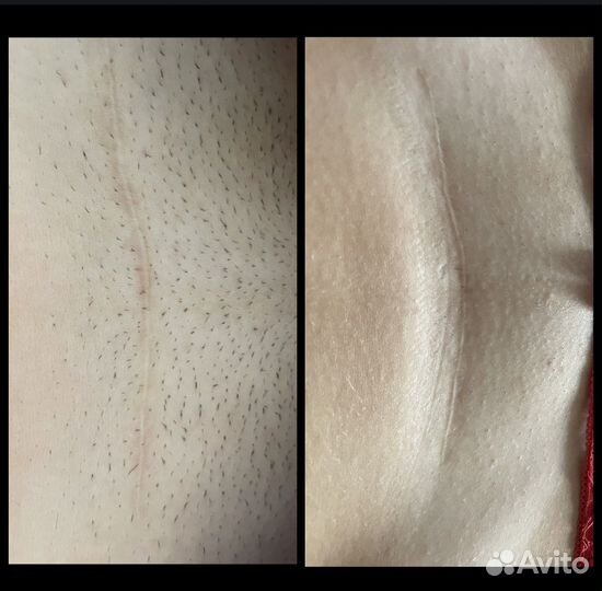 Лазерная эпиляция диодный лазер