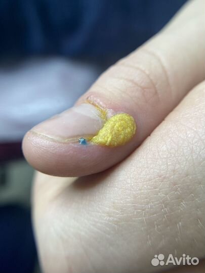 Подолог/бородавки/медицинский педикюр