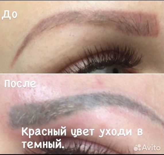 Лазерное удаление татуажа и татуировок