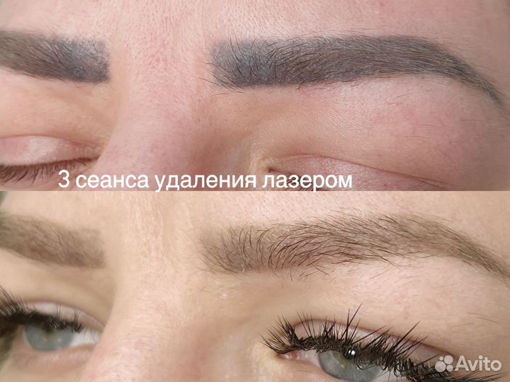 Удаление татуажа, микроблэйдинга