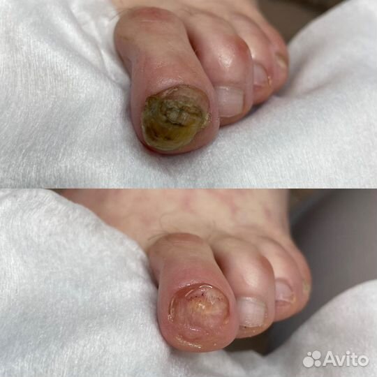 Педикюр Аппартный