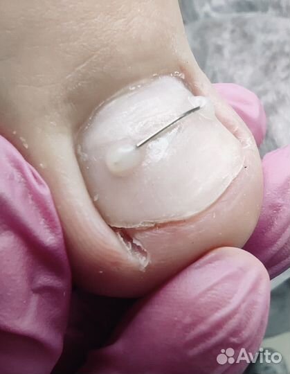 Подолог.Профессиональный педикюр. Срочный заказ