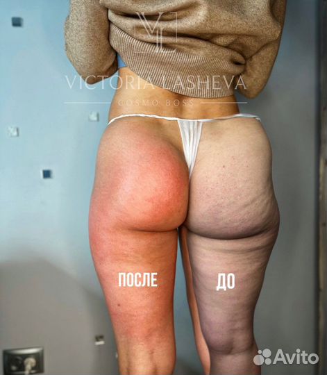 Аппаратный массаж тела