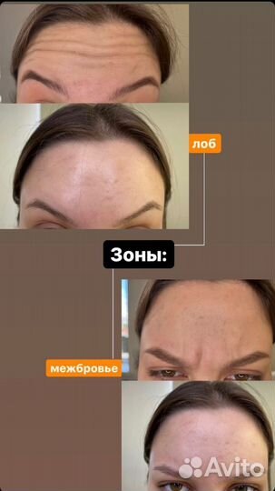 Ботокс для лица, глаз, лоб, межбровье, подмышки