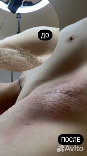 Депиляция воском и шугаринг