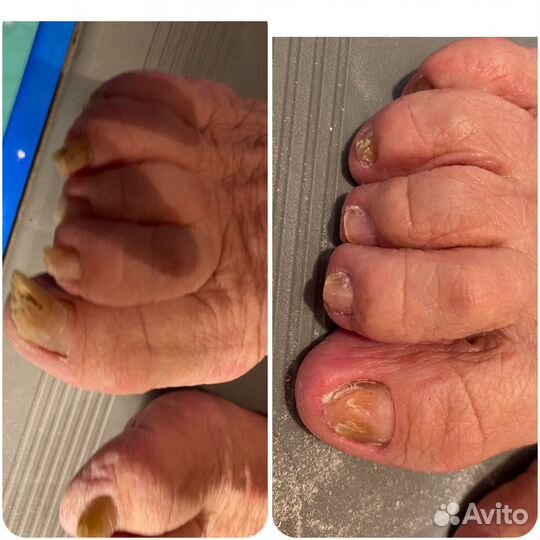 Педикюр пожилым на дому