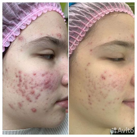Лечение акне аппаратом навсегда