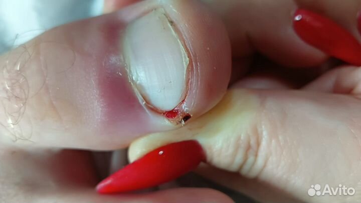 Педикюр подолог, вросший ноготь