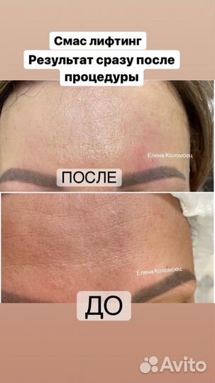 Smas лифтинг на лицо