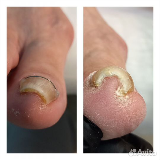 Подолог(сложные ноги,трещины,вросший но