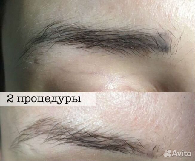 Удаление татуажа ремувером