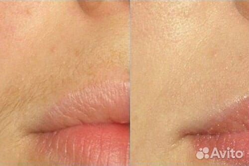 Депиляция воском