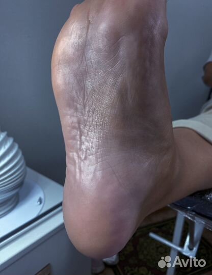 Вросший ноготь, грибок. педикюр