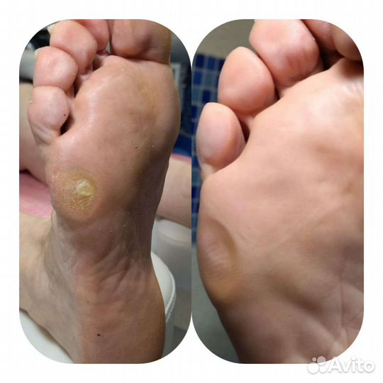 Лечебный педикюр любой сложности