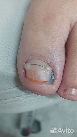 Педикюр подолог, вросший ноготь