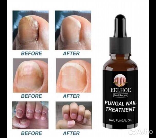 Ногтевое противогрибковое средство