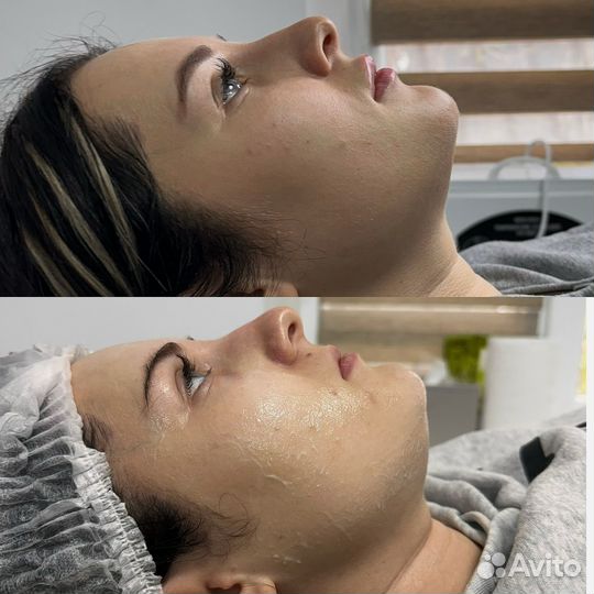 Липолитики, худое лицо, худое тело