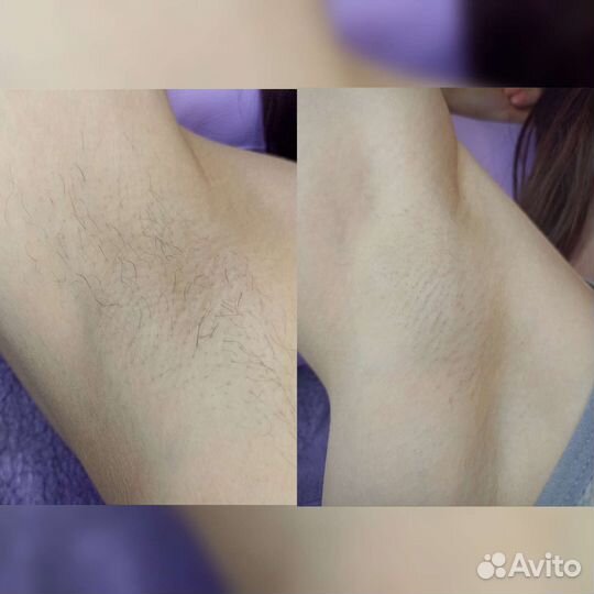 Шугаринг на дому