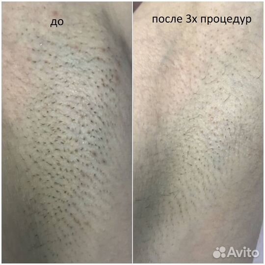 Лазерная эпиляция Элос