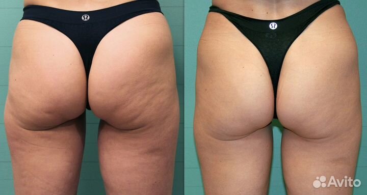 Модели на Липолазер боков