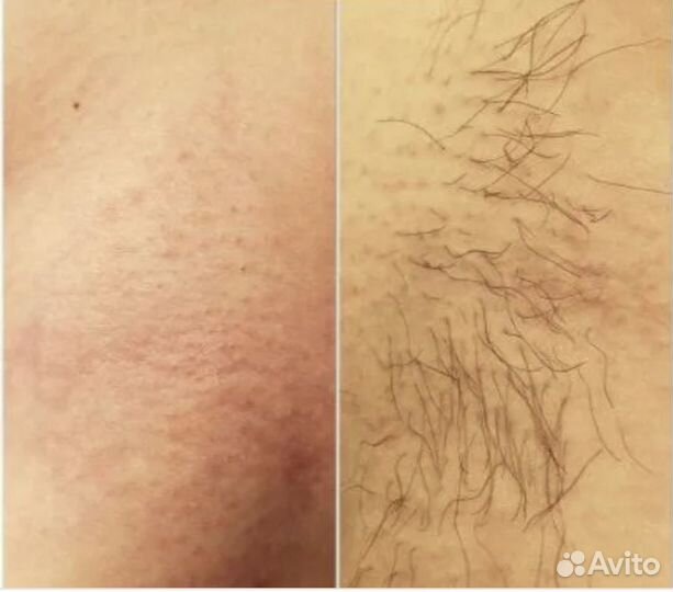 Мастер электроэпиляции