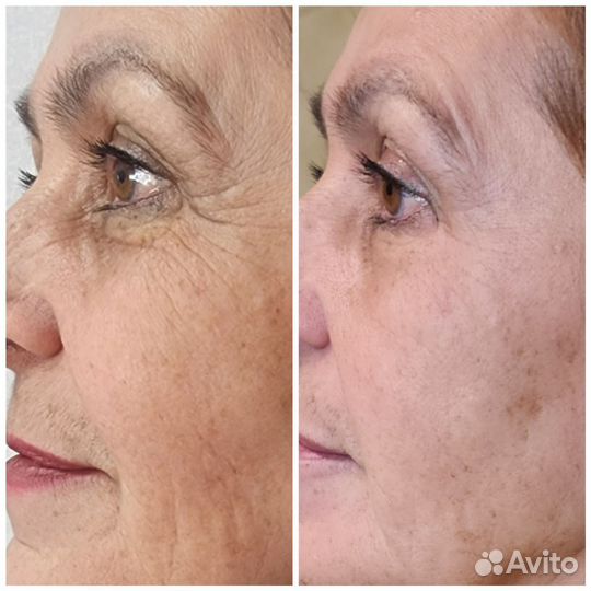 Модель на ботокс лица