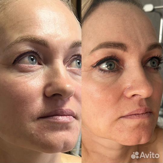 РФ лифтинг Чистка Омоложение подтяжка лица