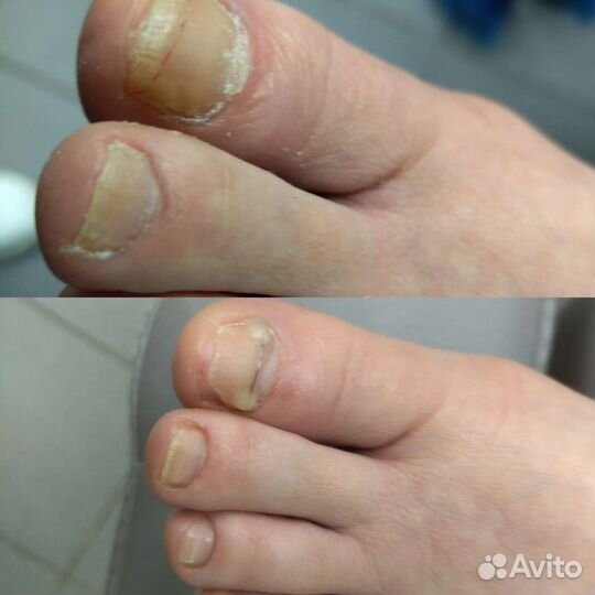 Медицинский педикюр подолог. Выезд на дом