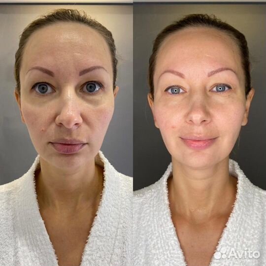 Требуются модели на Smas лифтинг