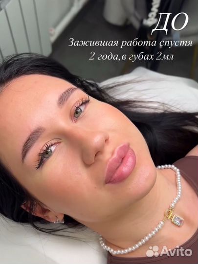 Контурная пластика губ