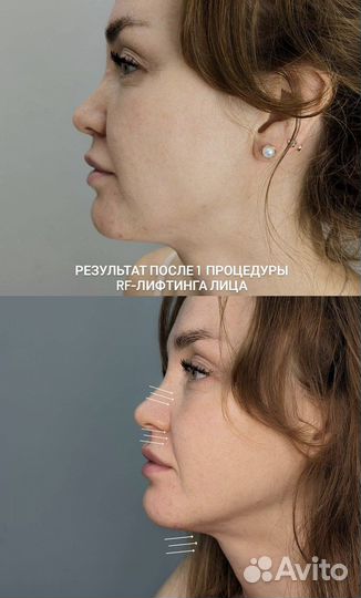 Омоложение лица рф-лифтинг
