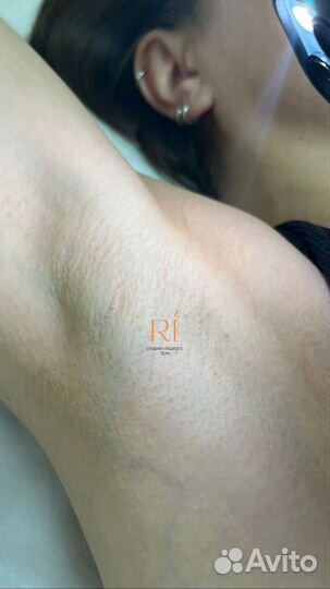 Лазерная эпиляция обучение