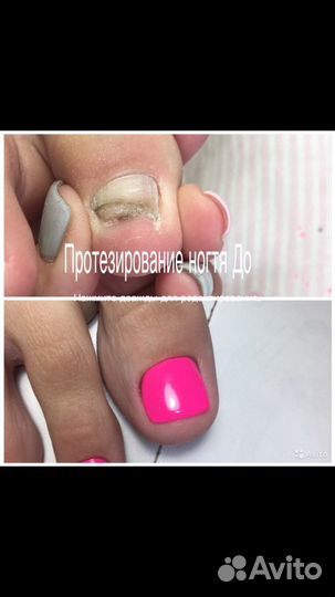 Медицинский педикюр,маникюр выезд на дом