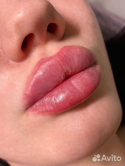 Увеличение губ